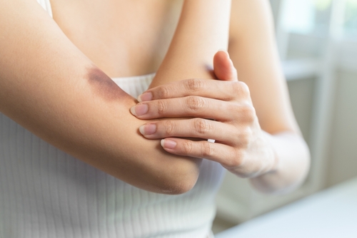 A close-up of a woman's arm showing a large, dark bruise on her elbow, with her other hand gently holding the injured area.