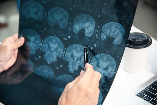 A medical professional examining and pointing at brain scan results during a review of head injury findings.